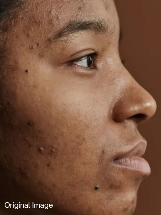 Skin correction, after